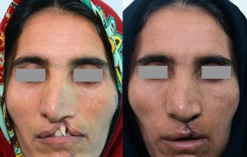 یاسوج قبل وعمل 2